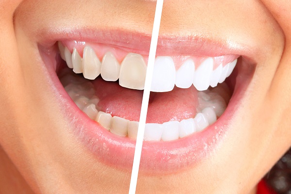 Popular Cosmetic Dentistry Options For Teeth Discoloration